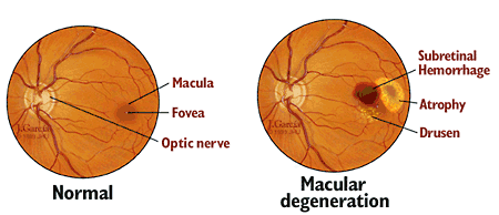 The Global Market of Age-related Macular Degeneration Exceeds Tens of Billions of Dollars